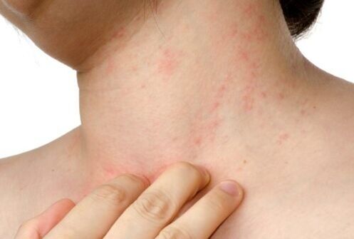 alergija na podkožne parazite