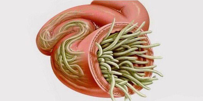 črvi v črevesju